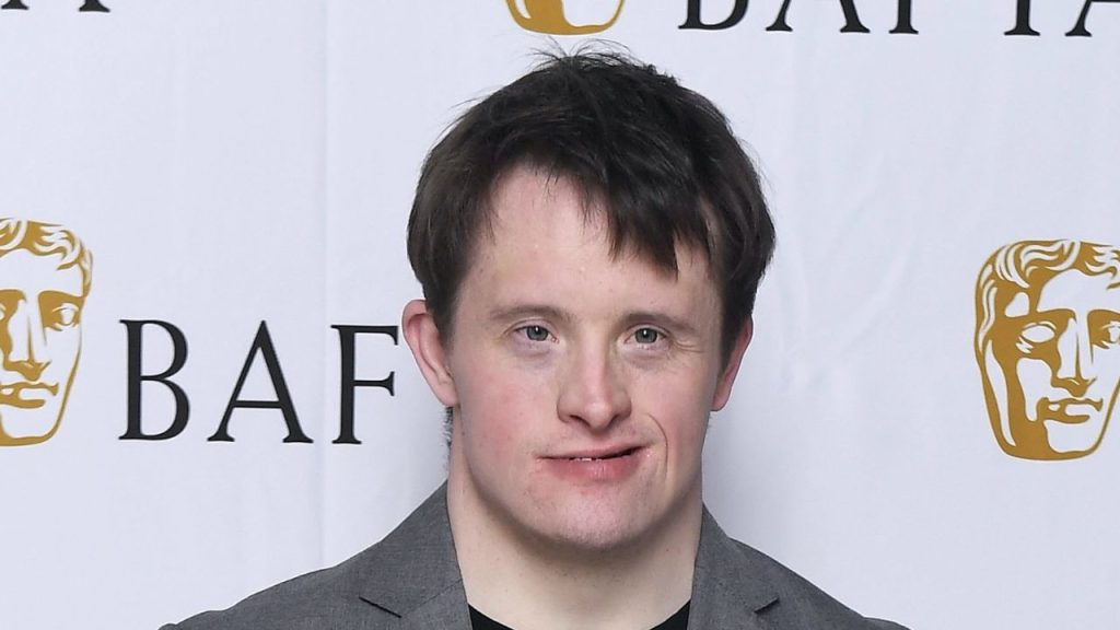 Famous Celebrities with Noonan Syndrome Making an Impact celebrities with noonan syndrome